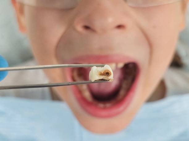 Best Emergency Dentist for Lost Fillings or Crowns in Aiea, HI